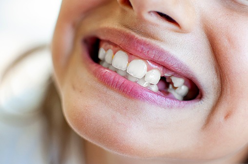 Mơ Thấy Mẻ Răng Là Điềm Tốt Hay Điềm Xấu? Đánh Số Gì Khi Mơ Thấy Mẻ Răng?